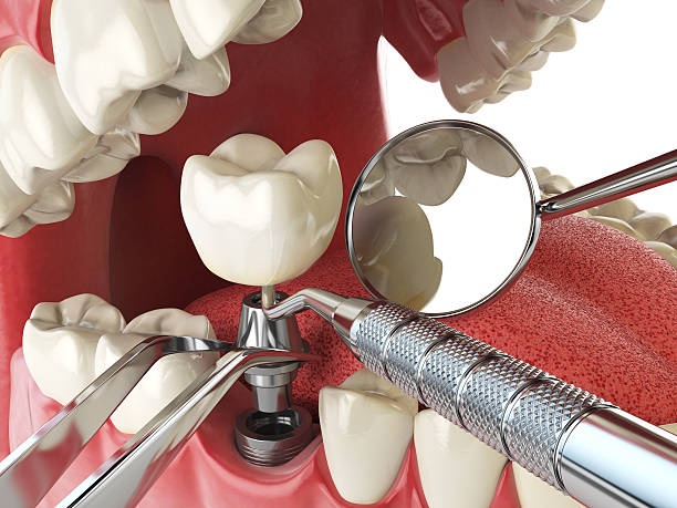 Best Emergency Dental Care for Sports Injuries in Montrose, MI