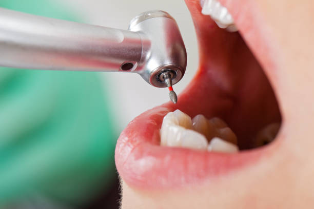 Best Knocked-Out Tooth (Avulsed Tooth) Treatment in Montrose, MI